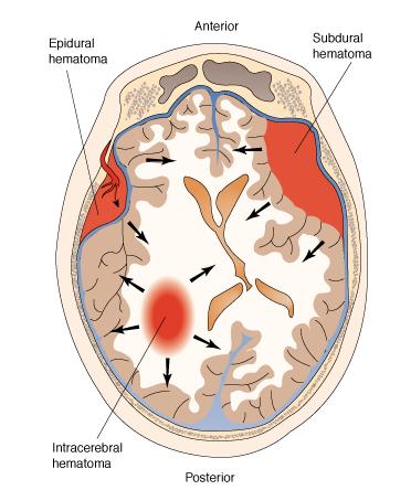 brain-hematoma1